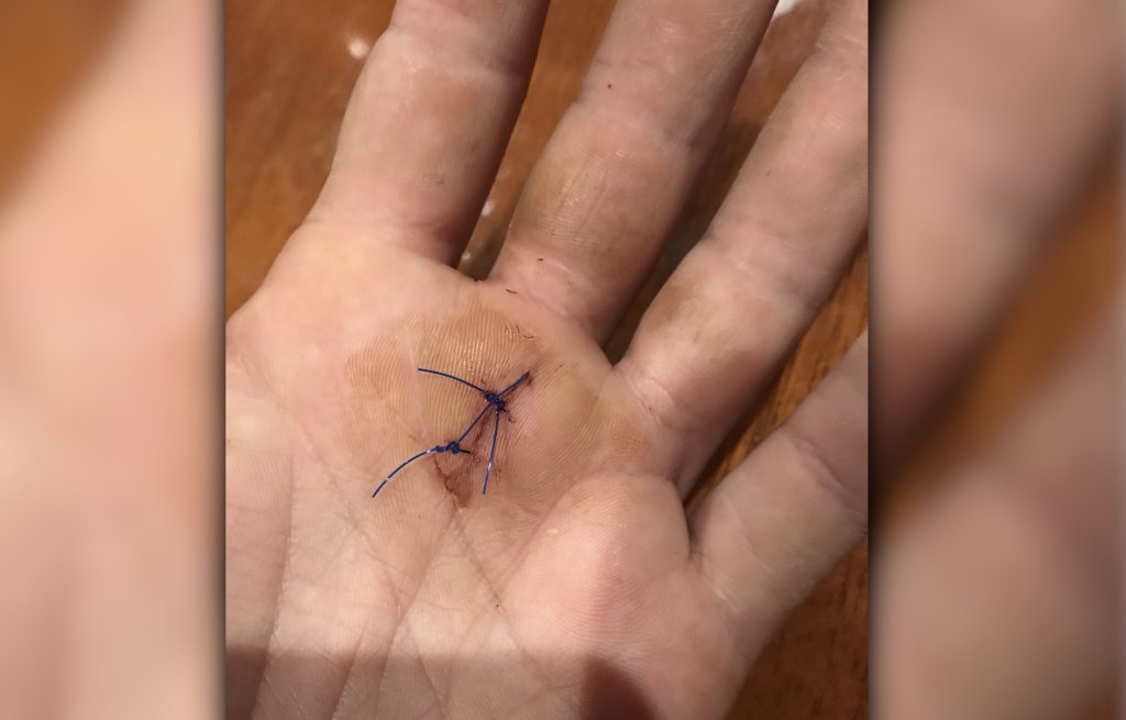 Meine Hand noch mit Fäden.